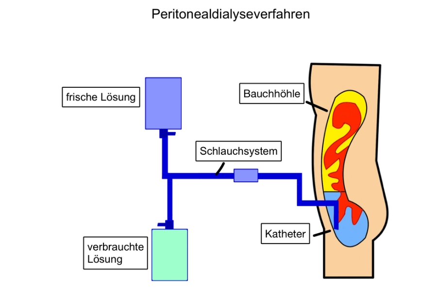Peritonealdialyseverfahren-Luckenwalde Peritonealdialyseverfahren - Dialyse Zentrum Luckenwalde